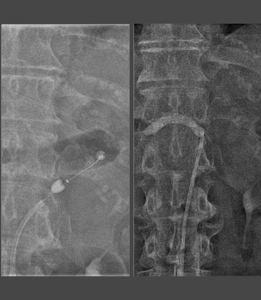 x-ray of cathetor in place