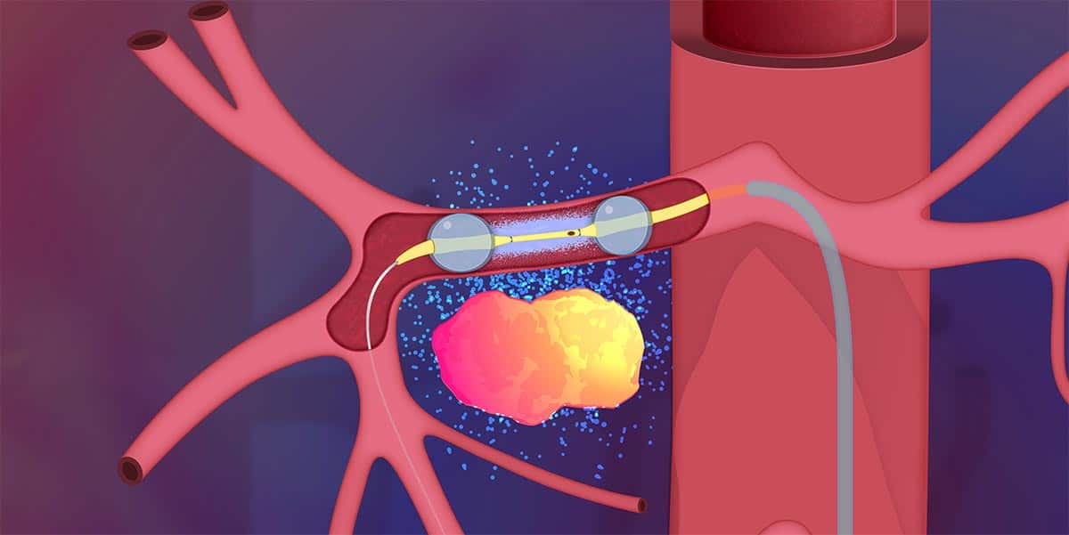 Illustration of RenovoCath Two Balloon Catheter System