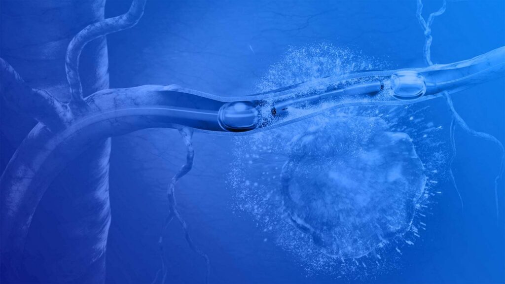 RenovoRx Catheter Illustration in all blue