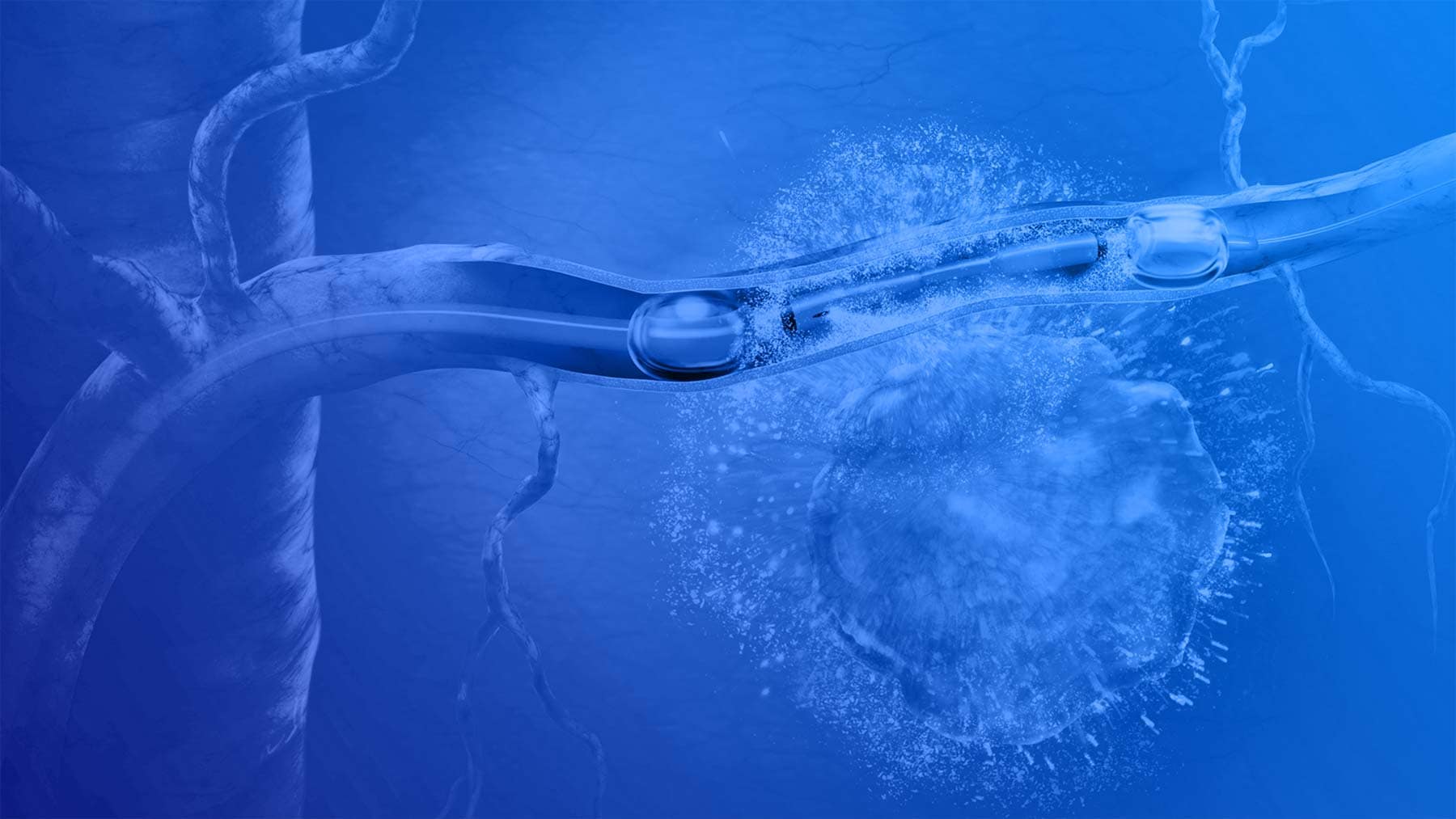 RenovoRx Catheter Illustration in all blue