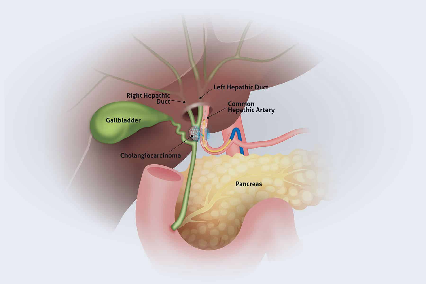 Bile duct cancer illustration