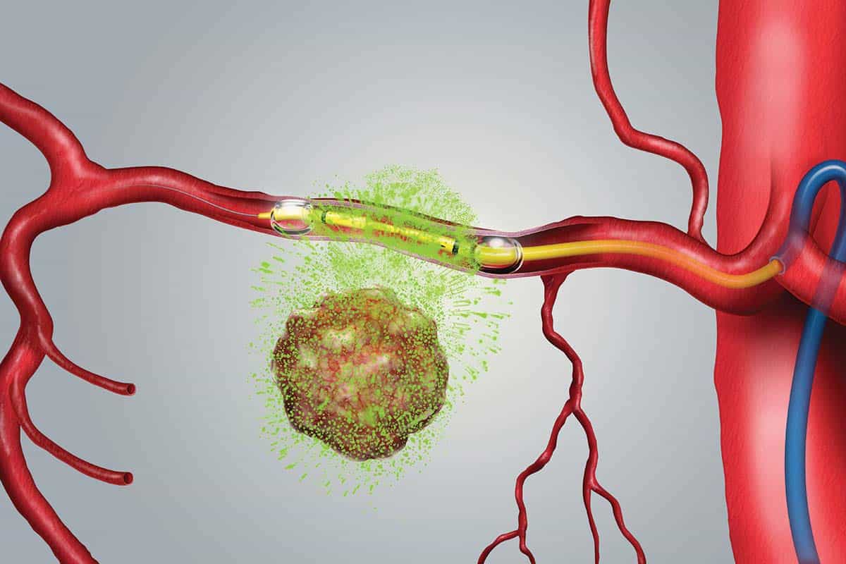 RenovoRx Catheter Illustration