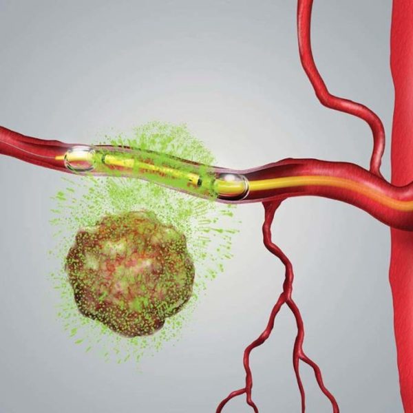 RenovoRx Catheter Illustration